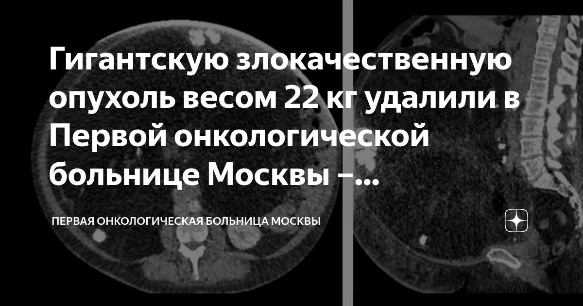 Гигантскую злокачественную опухоль весом 22 кг удалили в Первой ...