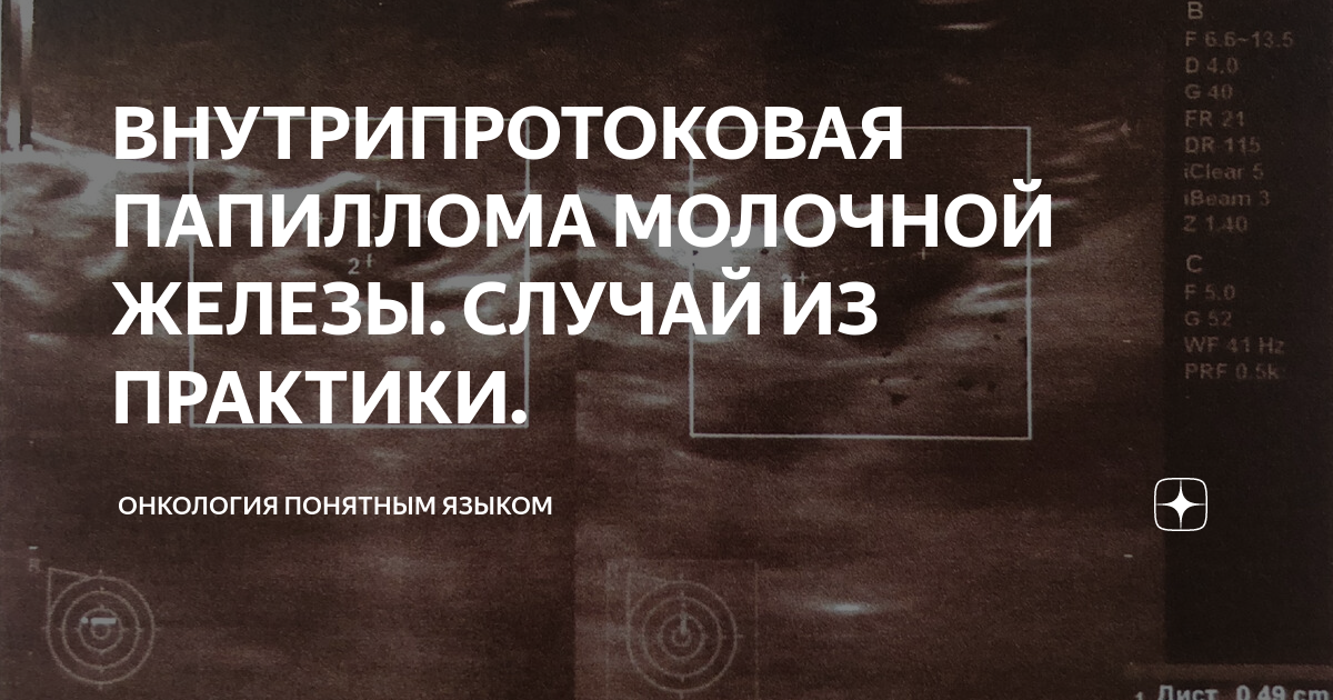 ВНУТРИПРОТОКОВАЯ ПАПИЛЛОМА МОЛОЧНОЙ ЖЕЛЕЗЫ. СЛУЧАЙ ИЗ ПРАКТИКИ ...