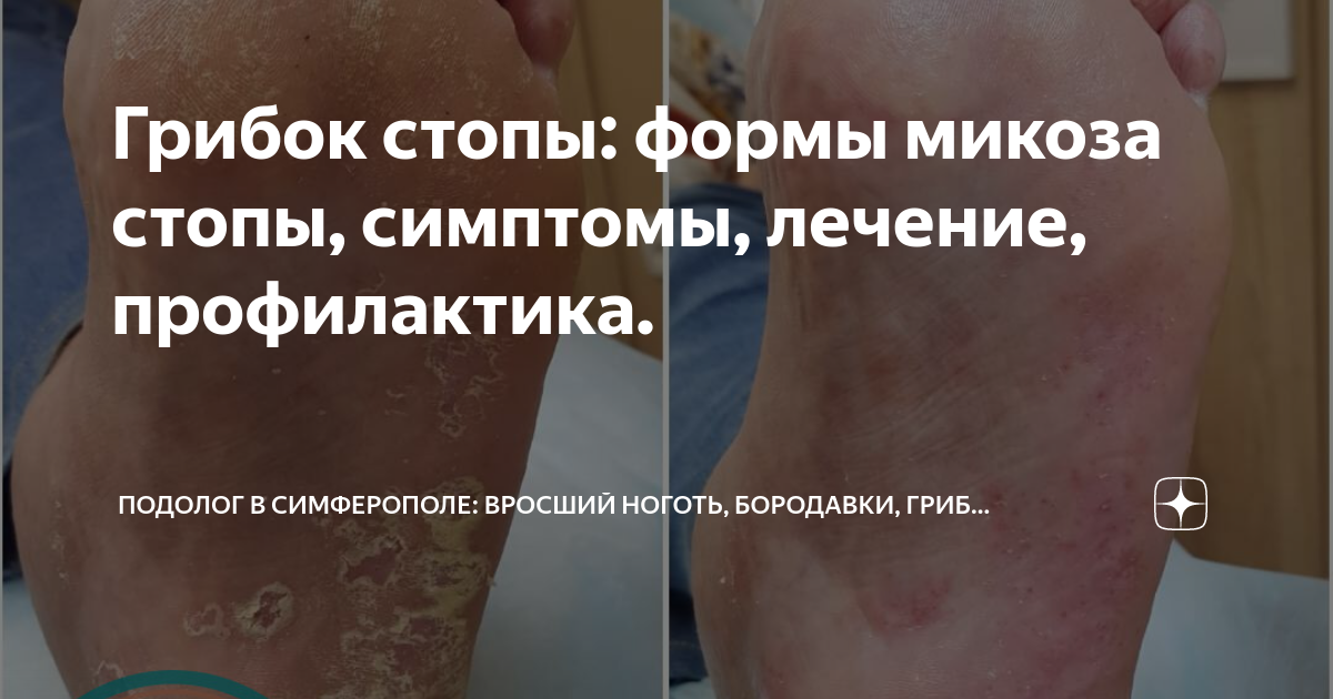Грибок стопы: формы микоза стопы, симптомы, лечение, профилактика ...