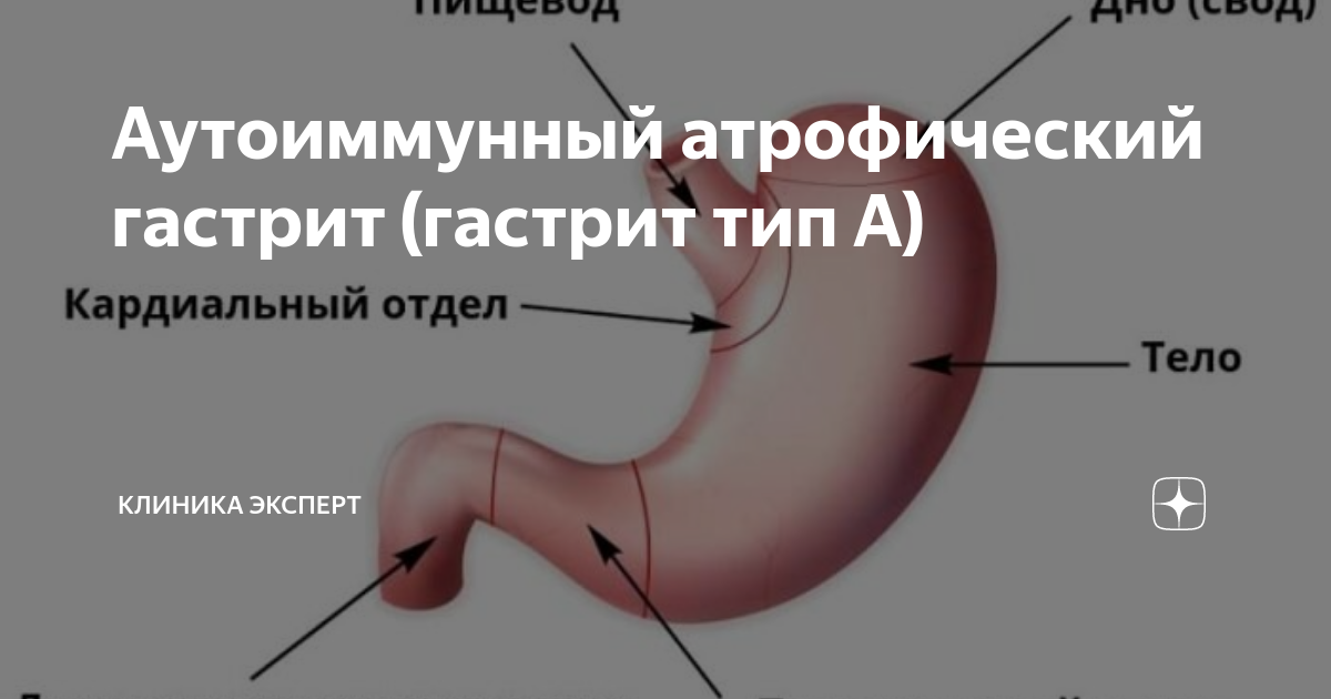 Аутоиммунный атрофический гастрит (гастрит тип А) | Клиника ЭКСПЕРТ ...