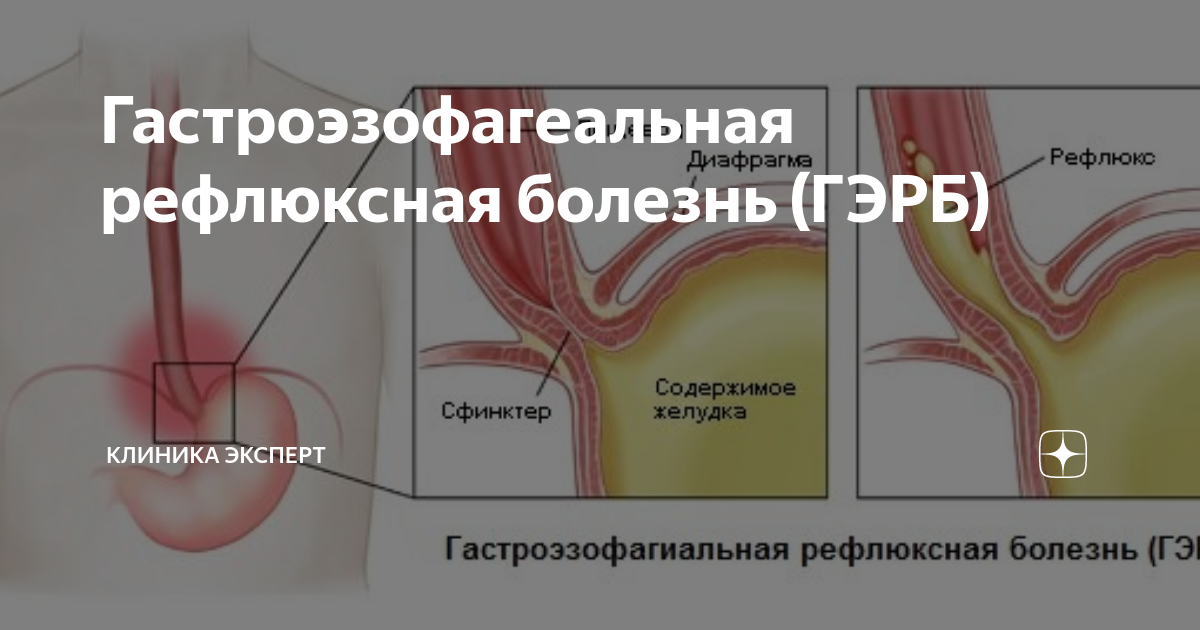 Гастроэзофагеальная болезнь