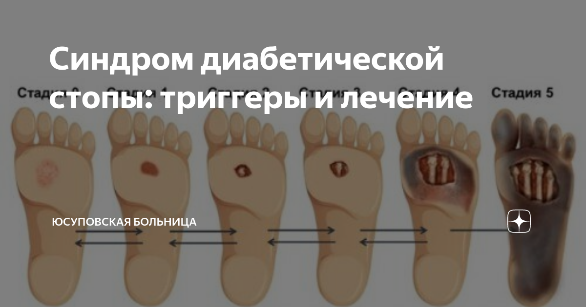 Синдром диабетической стопы: триггеры и лечение | Юсуповская больница ...