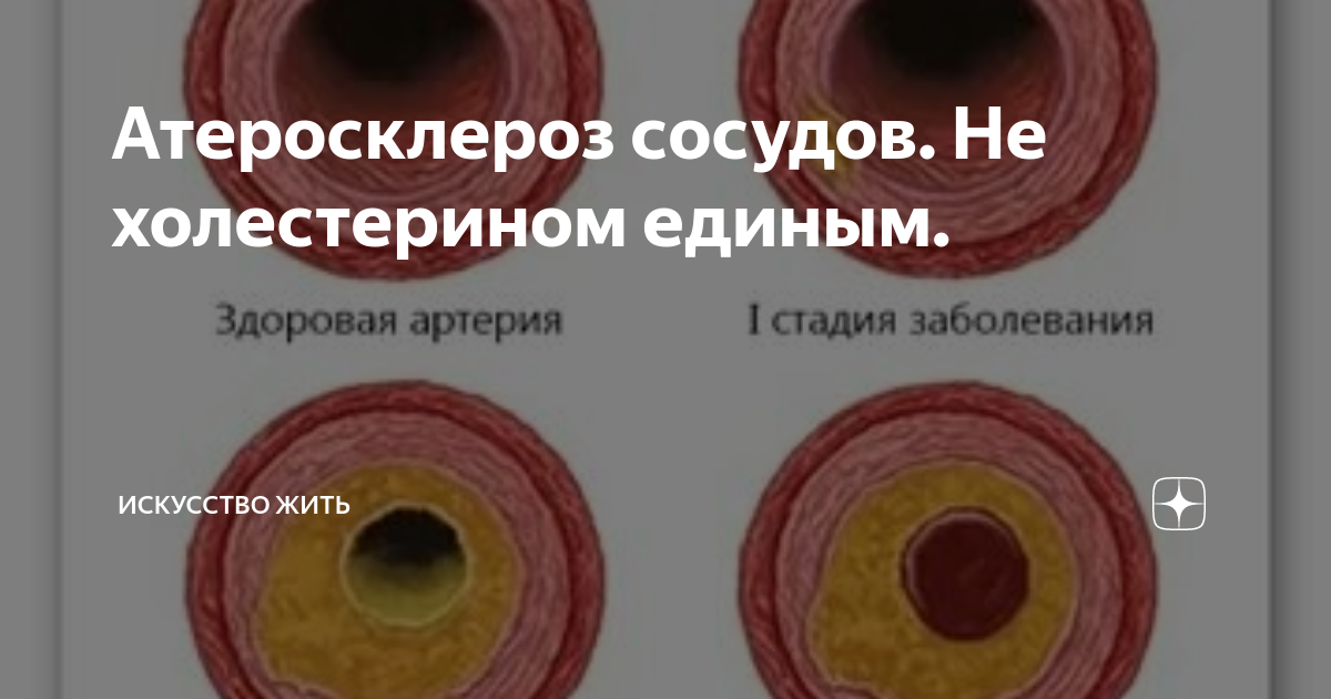 Как проверить сосуды на бляшки. Калина от атеросклероза сосудов. Причина расширенных сосудов. Как проверить сосуды на наличие тромбов и бляшек.