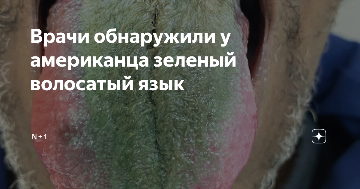 Врачи обнаружили у американца зеленый волосатый язык | N + 1 | Дзен