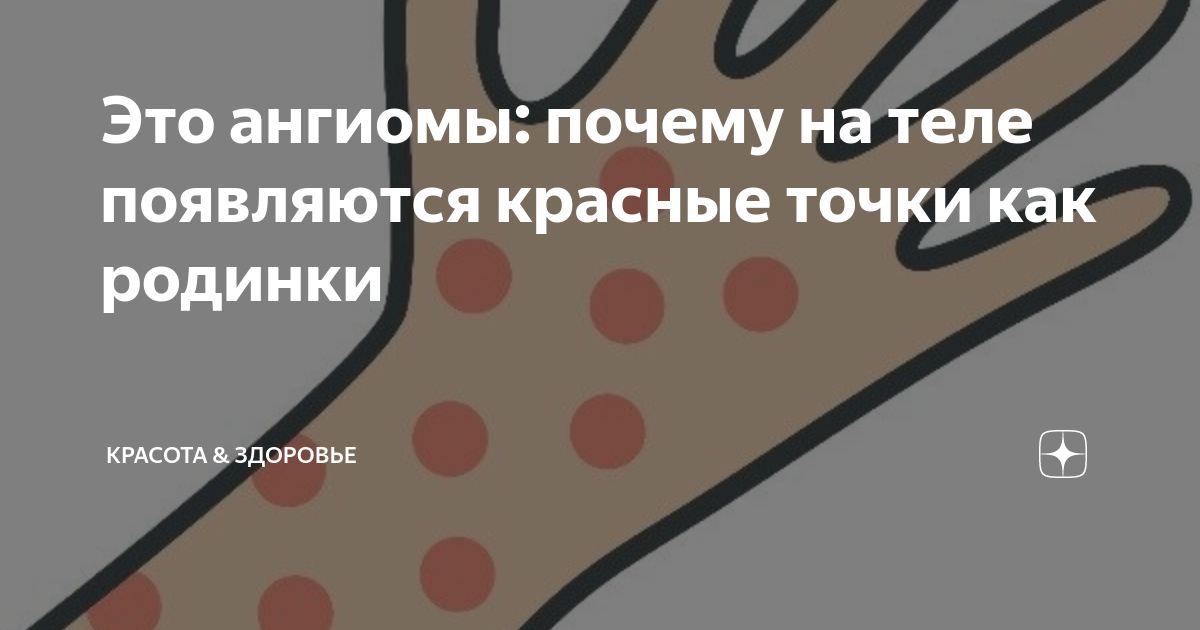 Это ангиомы: почему на теле появляются красные точки как родинки ...