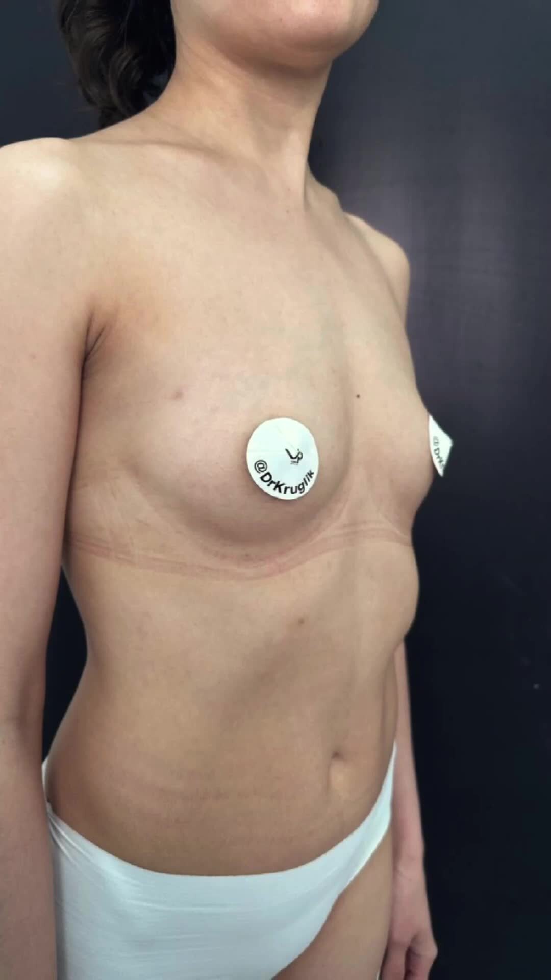 Breast Implant Surgery Performed In Thailand