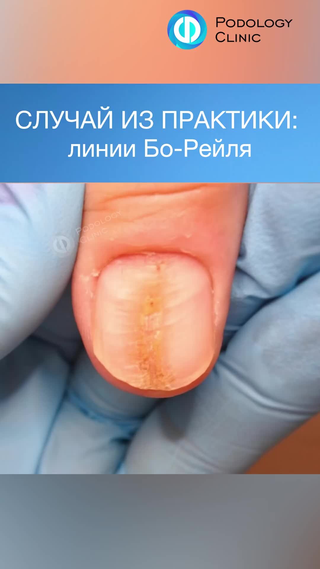КЛИНИКА ПОДОЛОГИИ ПОЛЁТ | Бугры на ногтях / волнистые ногти / Линии Бо ...