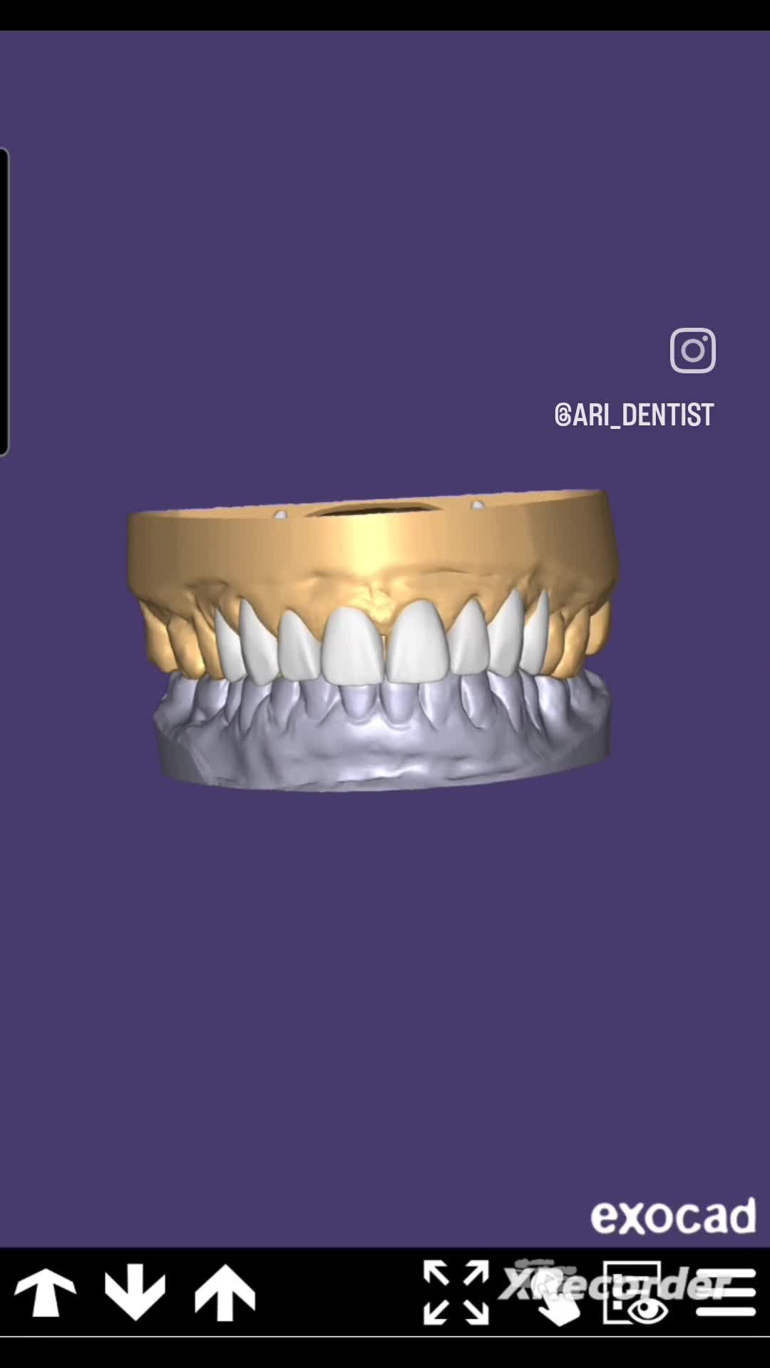 Фотокомпозитные виниры. Красивые передние зубы. Можно ли переделать зубы. Можно ли переделать зубы. Кривые улыбки.