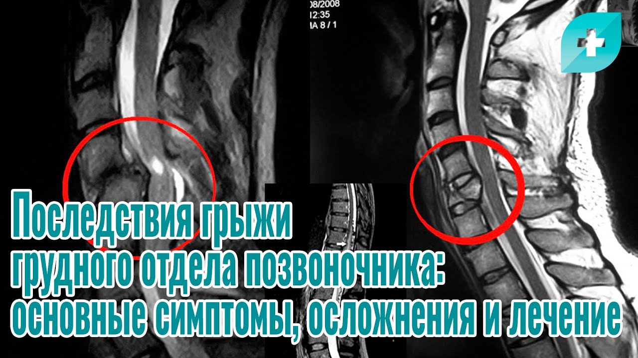 Симптомы грыжи грудного отдела у мужчин. Грыжа грудного отдела позвоночника. Грыжа грудного отдела позвоночника симптомы. Грыжа позвоночника грудного отдела симптомы у женщин. Грыжа позвоночника последствия