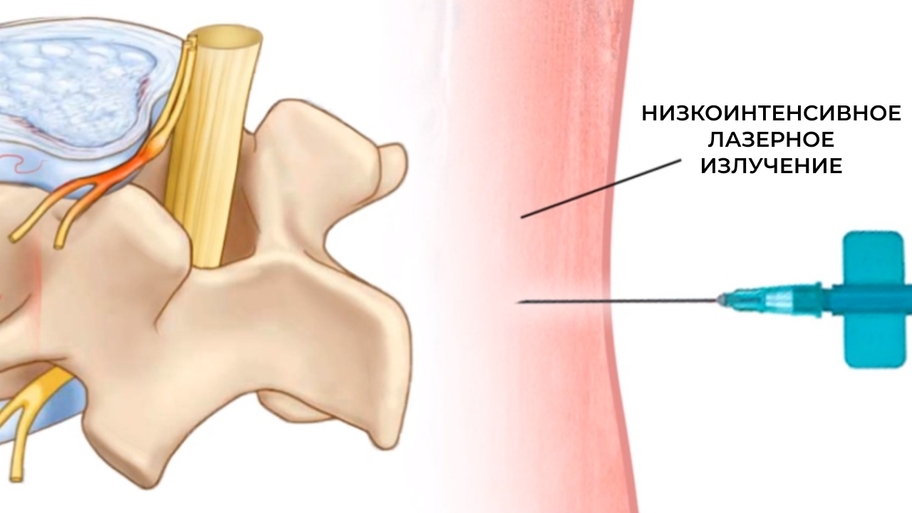 Лечу грыжу позвоночника