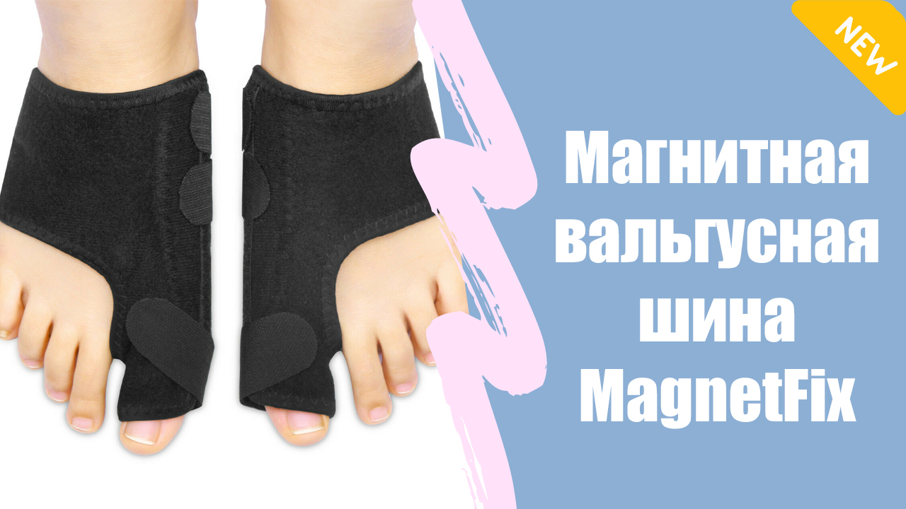 Как убрать вальгус. Деформация пятого пальца стопы (деформация тейлора). Вальгусная деформация большого пальца лечение. Кость на большом пальце ноги. Корректор большого пальца вальгус.