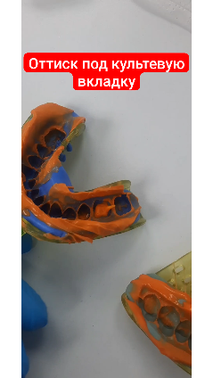 Оттиск для штифтовой культевой вкладки. Моделировка культевой штифтовой вкладки. Оттиск для вкладки. Культевые вкладки лабораторным методом. Бюгельные протезы.