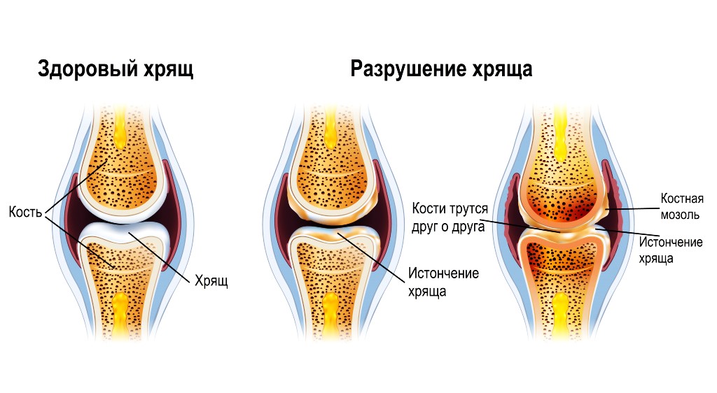 истончение хряща. ревматоидный гонартроз коленного сустава. истончение хряща. истончение хряща. деформирующий артроз коленного сустава степени.