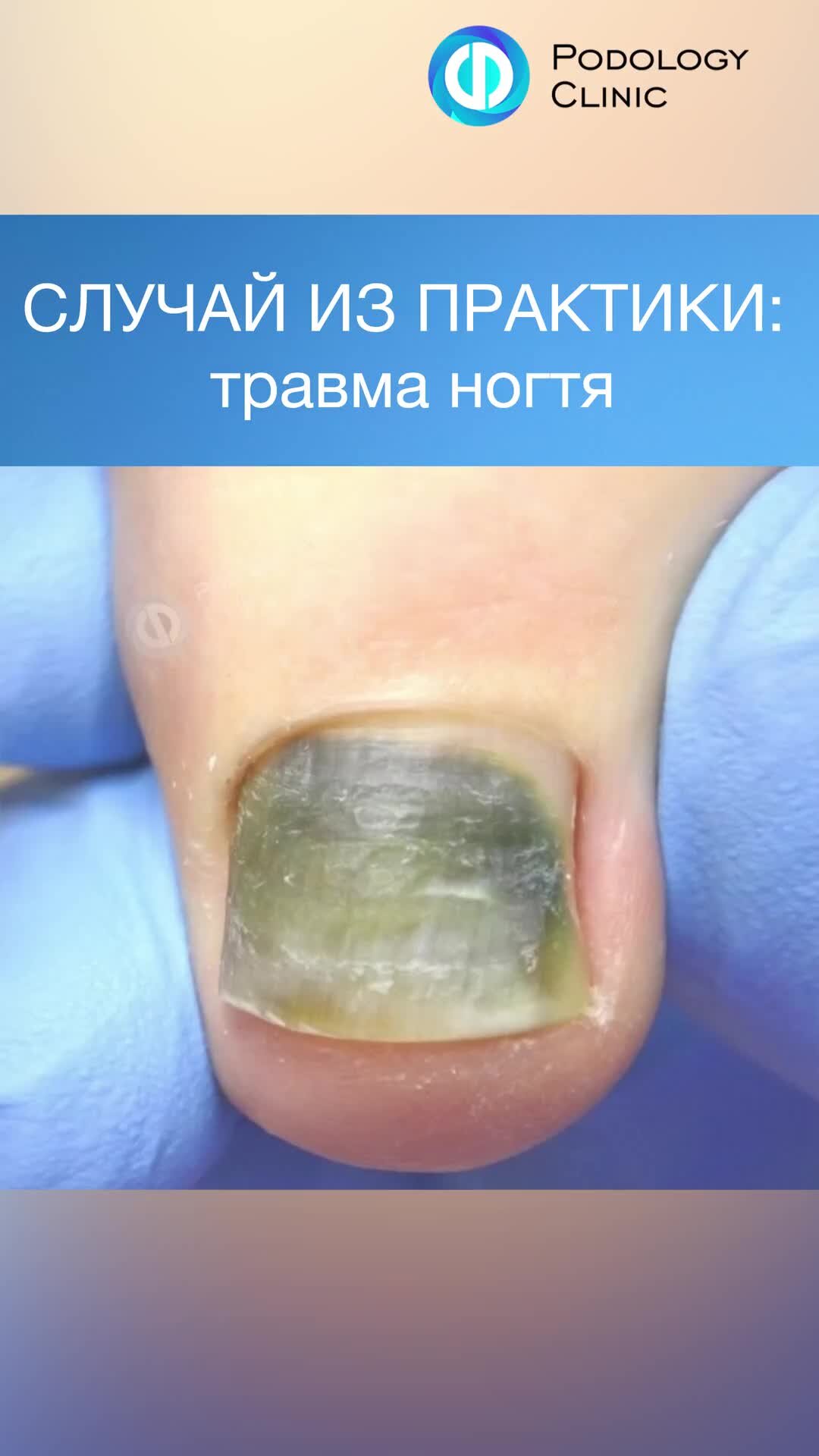 КЛИНИКА ПОДОЛОГИИ ПОЛЁТ | СЛУЧАЙ ИЗ ПРАКТИКИ: травма ногтя / почернел ...