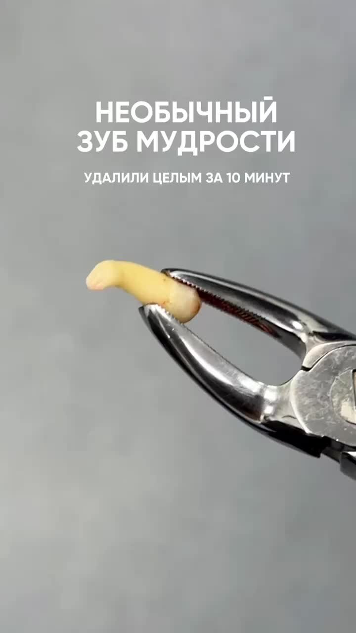 Зубы без зубов мудрости. Мудрости верхнего. Неправильный рост зуба мудрости. Челюсть без зубов мудрости. Альвеолит хирургическая стоматология.