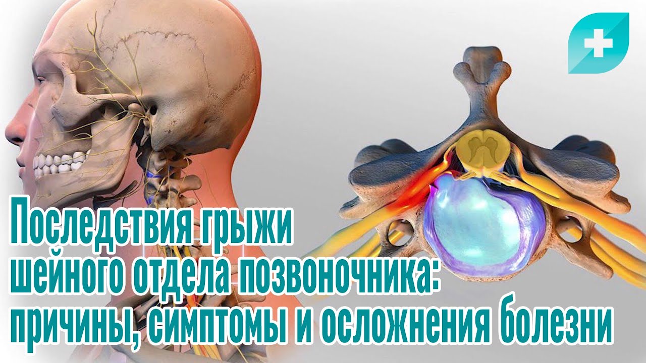 Последствия грыжи позвоночника. Грыжа позвоночника последствия. Грыжа шейного отдела позвоночника лечение. Осложнения грыж