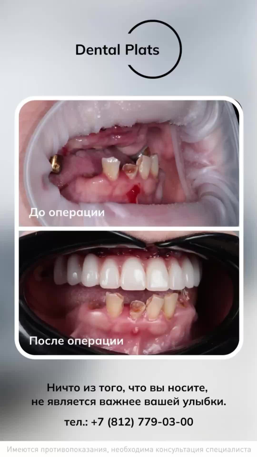 Dental Plats - стоматология СПБ | Методика ProArch. До операции и после!  #dentalplats #зубызаодин #proarch #имплантациязубов | Дзен