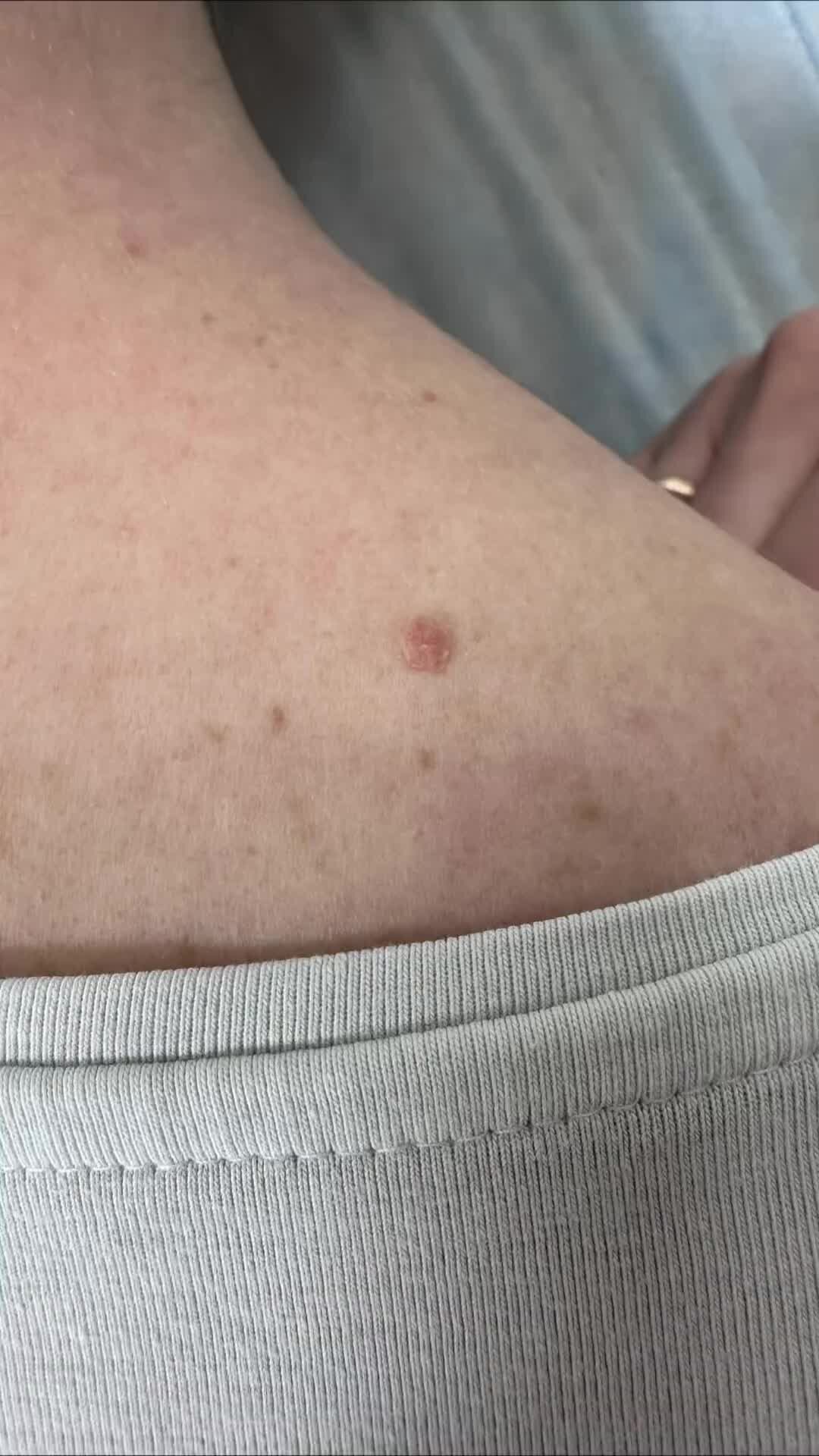 Дерматолог Ольга Антонова | Как удаляется внутридермальный невус? С ...