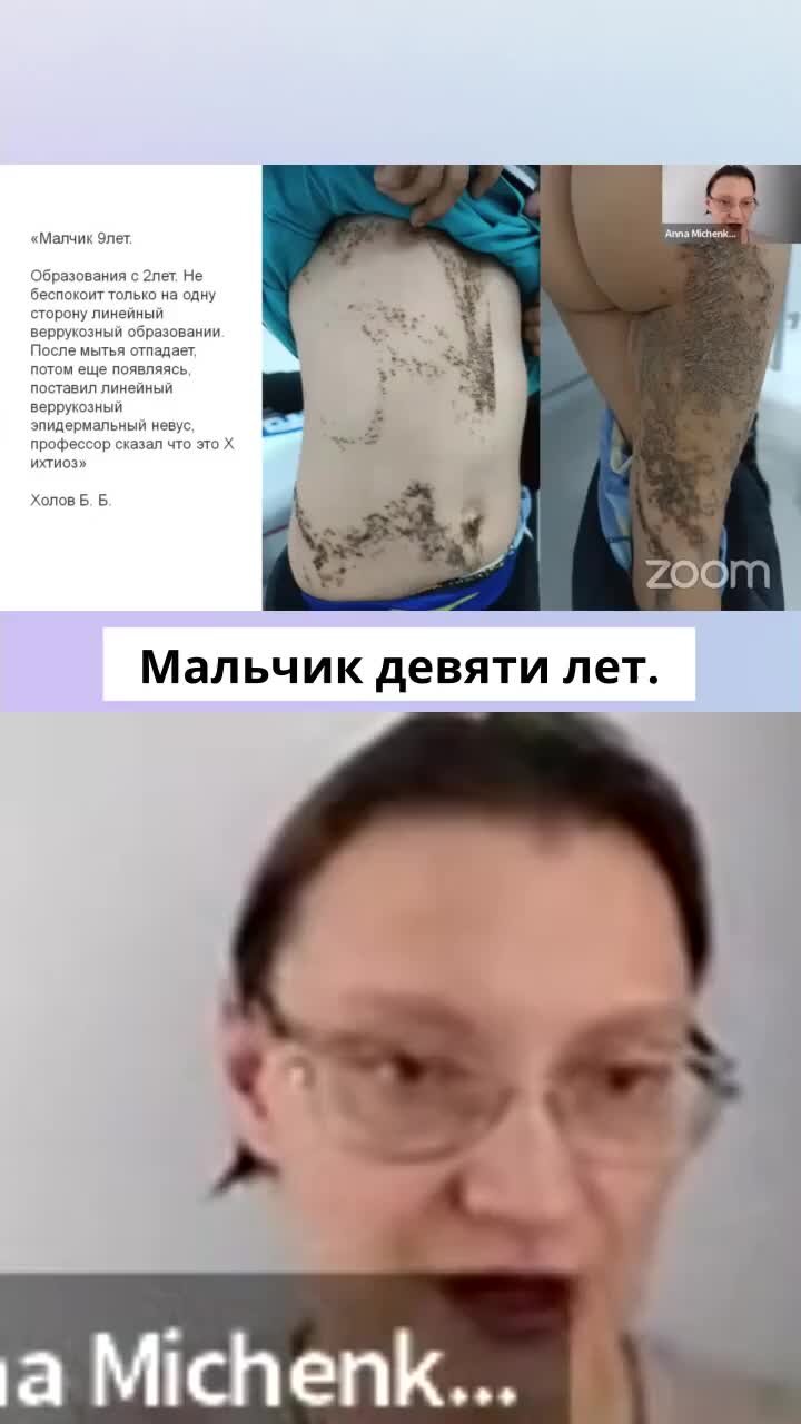 Невусы у детей