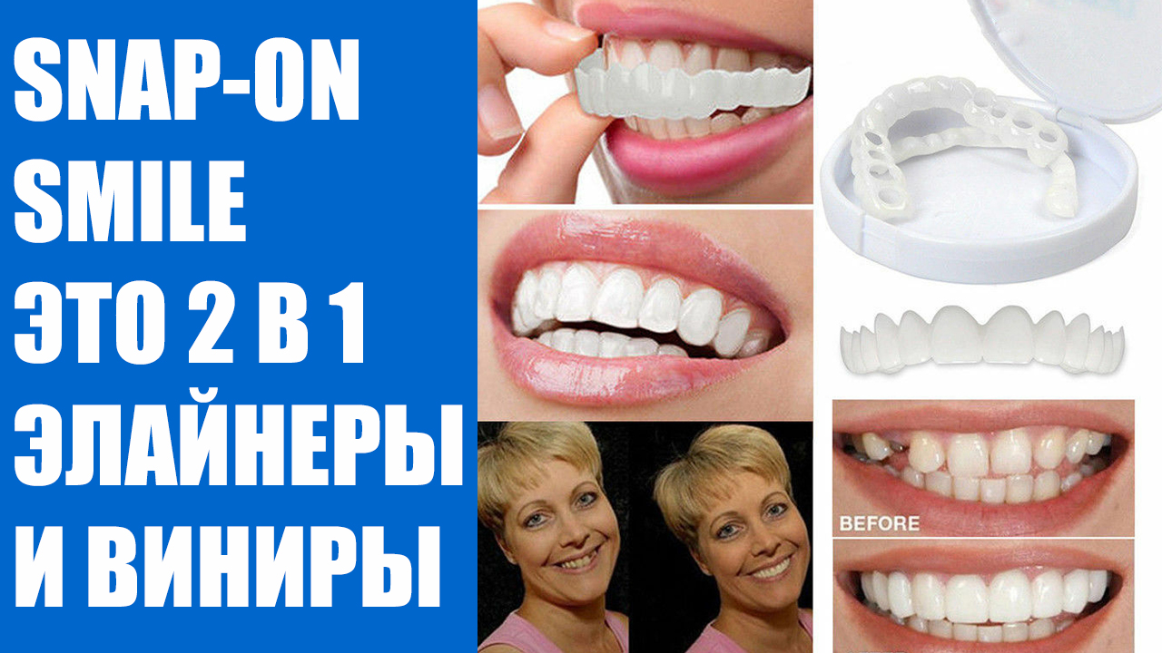 Вставные зубы виниры. ). Виниры trusmile. Съемные виниры snap-on smile (490 руб. Накладные зубы snap on smile.