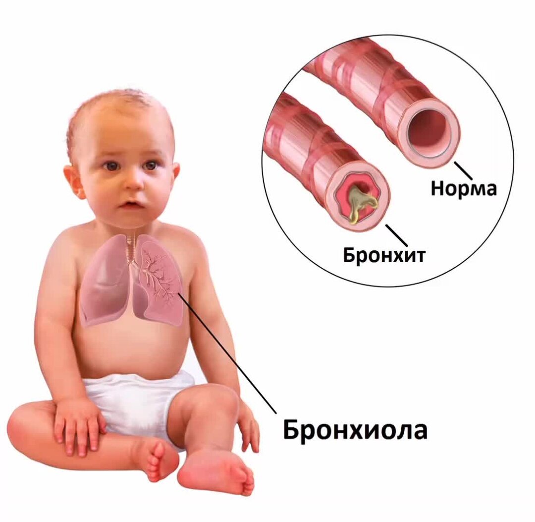 острый бронхит у детей симптомы. хронический бронхит одышка. бронхит долго не проходит кашель. характерные симптомы бронхита. сухой и влажный кашель отличия.