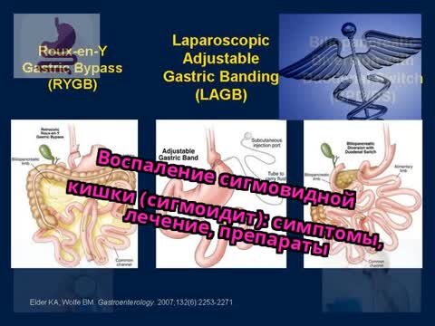 Сигмоидит: воспаление сигмовидной кишки • Здоровье столицы