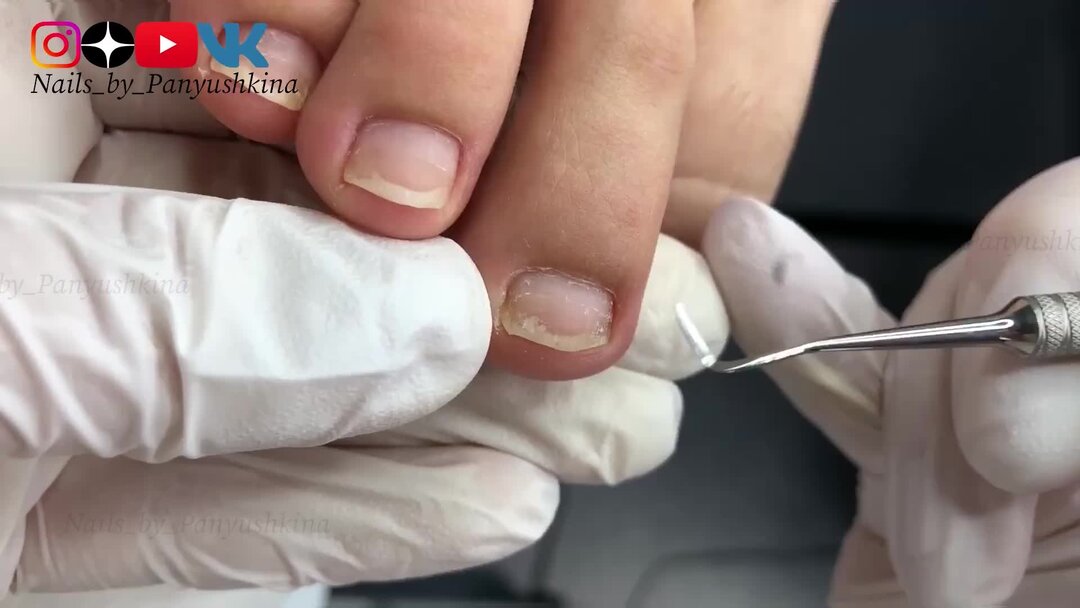 НОГТИ ПОСЛЕ ГРИБКА| ГИГИЕНИЧЕСКИЙ ПЕДИКЮР| ПОКРЫТИЕ ЛАКОМ| КАК ...