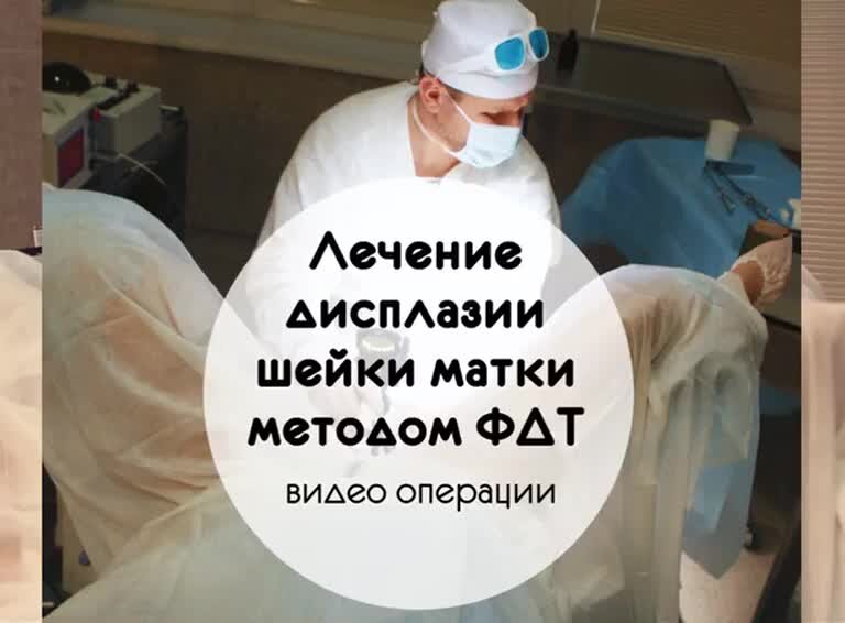 Конизация шейки при дисплазии отзывы. Беременность после фотодинамической терапии шейки матки. Радиологический метод лечения шейки матки.