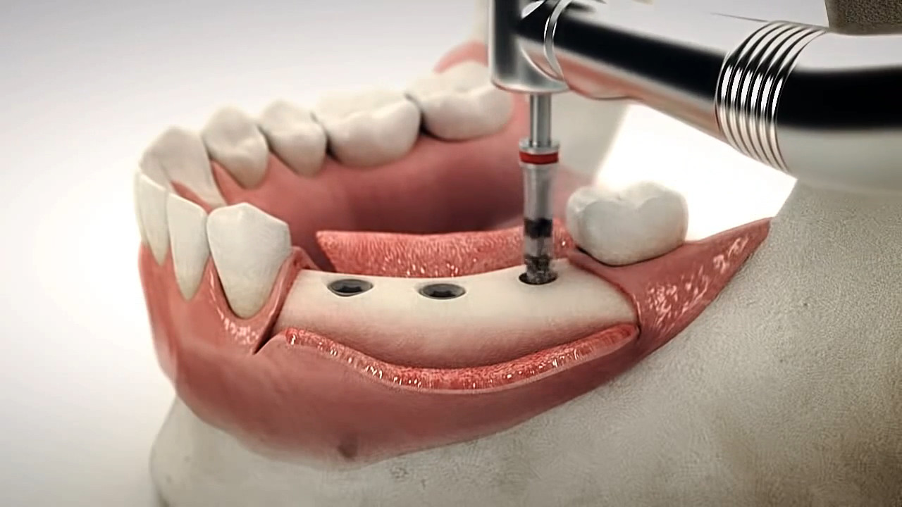 имплантация зубов без костной пластики. имплант osstem. этапы имплантации зубов. установка импланта зуба видео. имплантат формирователь десны абатмент.