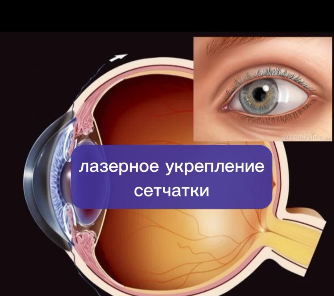 Укрепить сетчатку глаз без операций.