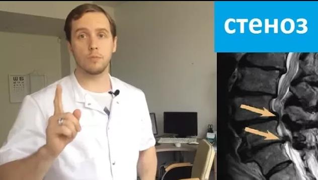 Епифанов грыжа. Епифанов грыжа. Доктор епифанов. Резорбция секвестрированной грыжи. Епифанов грыжа.