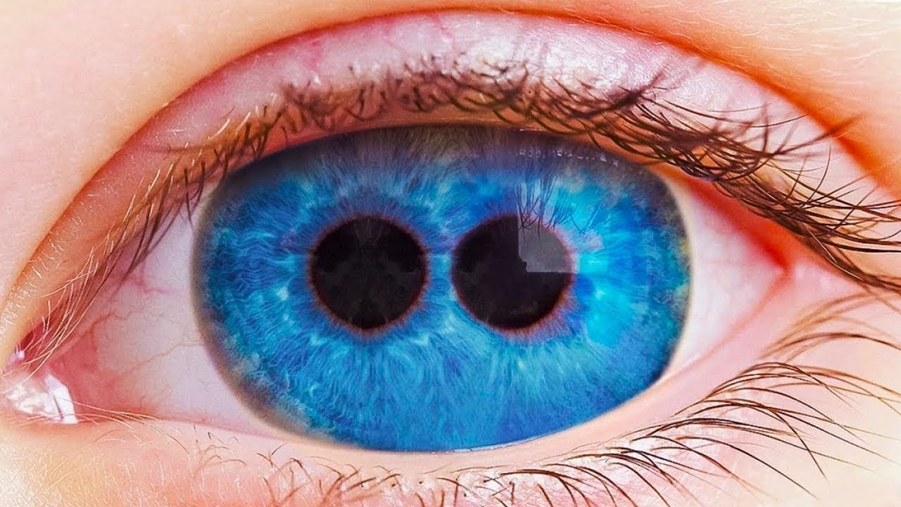 Пупула дуплекс заболевание. Поликория двойной зрачок. В каждом глазе по два зрачка. Глаз с несколькими зрачками. Пупула дуплекс заболевание.