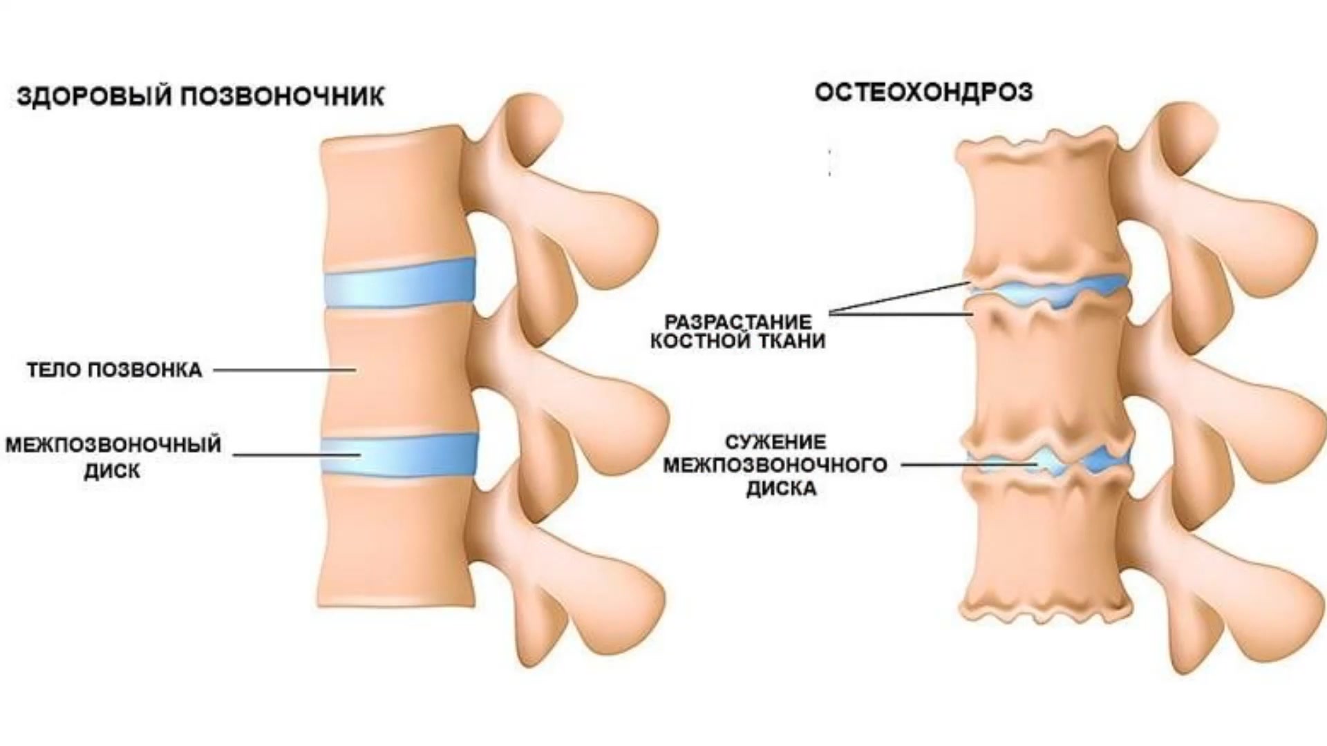 Остеохондроз годность