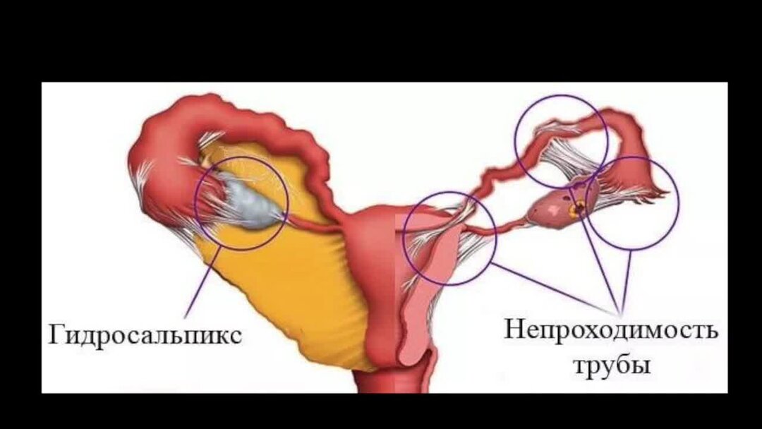 Непроходимость маточных труб. Гидросальпинкс пиосальпинкс. Гидроэхолокация маточных труб. Труднопроходимость маточных трубах.