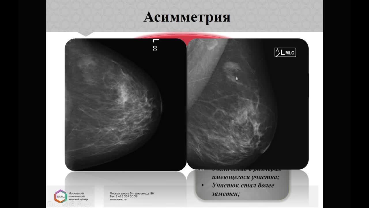 Образование молочной железы bi rads 2. Маммография. Система bi-rads. Распечатка маммографии на бумаге. Лекции по маммографии для рентгенологов.