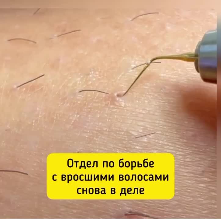 Вот он ВРАГ: убить или милосердие? | Электроэпиляция от Натальи ...