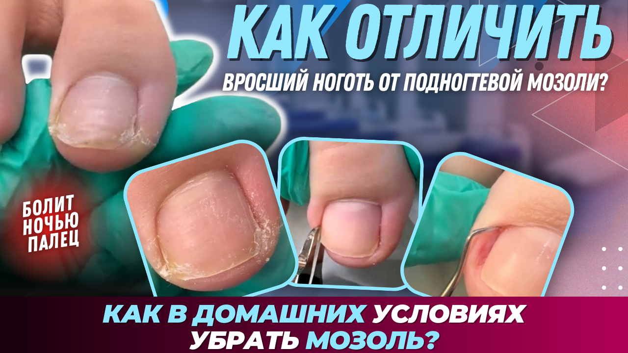 Что такое мозоль и как от неё избавиться — блог медицинского центра ОН Клиник