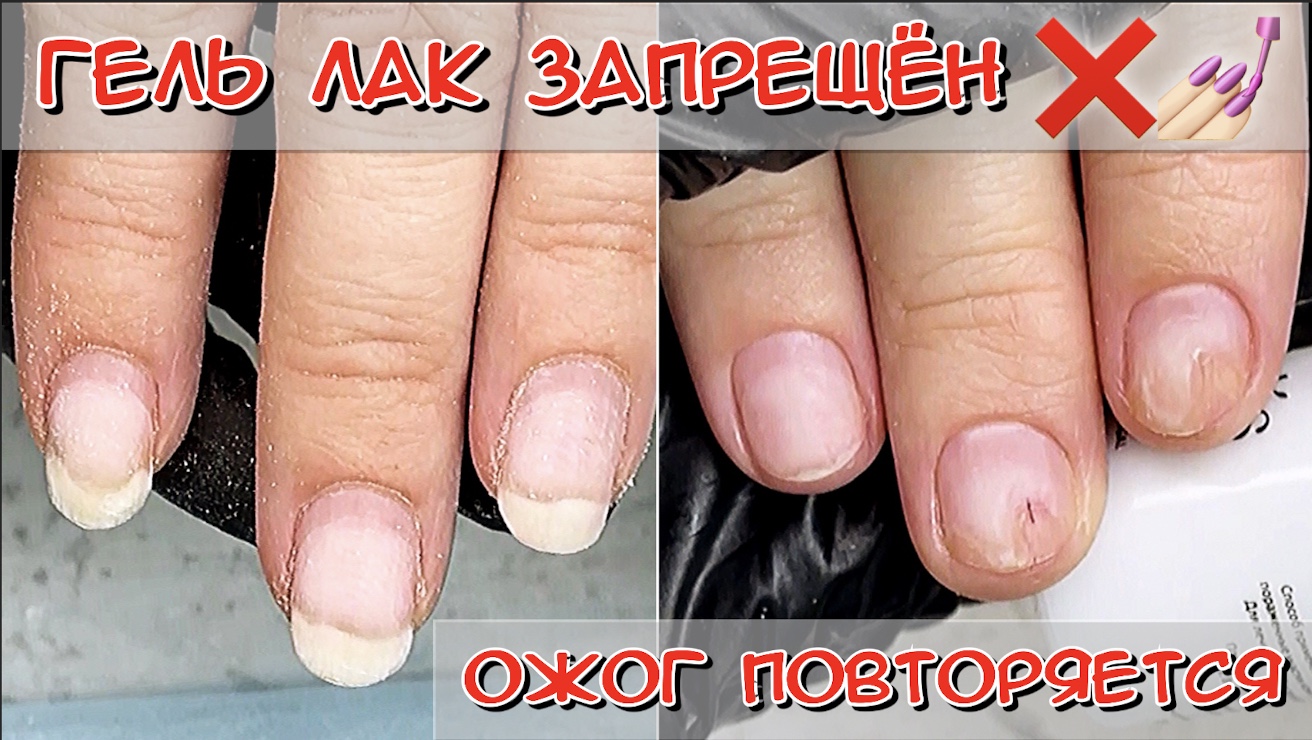 Литеральный онихолизис. Онихолизис синегнойная палочка. Онихолизис боковых стенок. Онихолизис ногтей можно ли гель лак. Онихолизис ногтей лекарство.