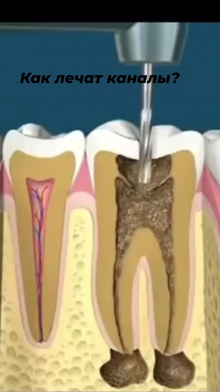 Прочистка каналов зуба