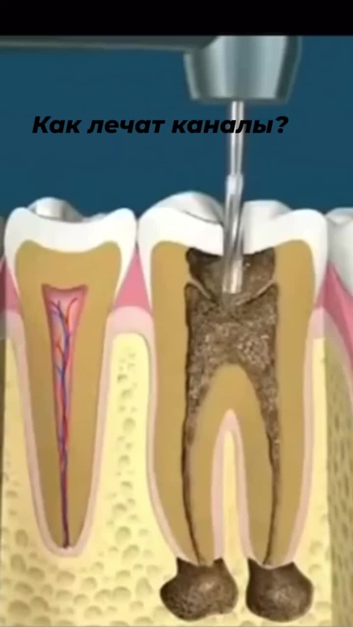 Чистка каналов зуба