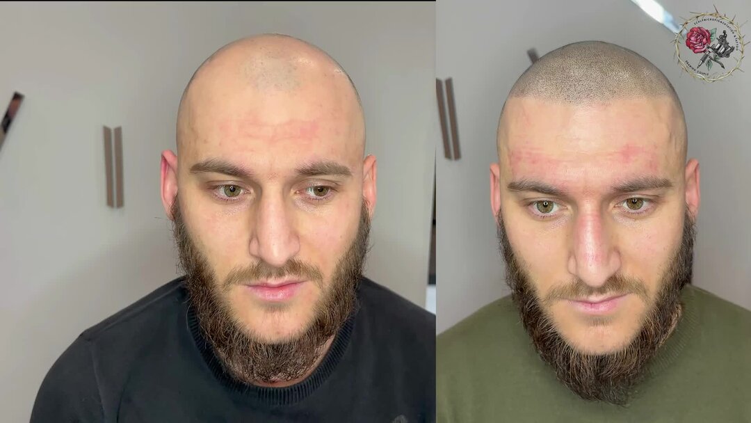 Пересадка волос 2023. Пересадка волос 2000 графтов. Пересадка волос 2023. Прически после пересадки волос. Пересаживание волос на голове.