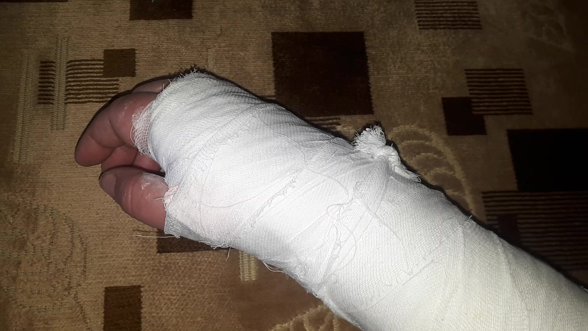 Сломанная рука