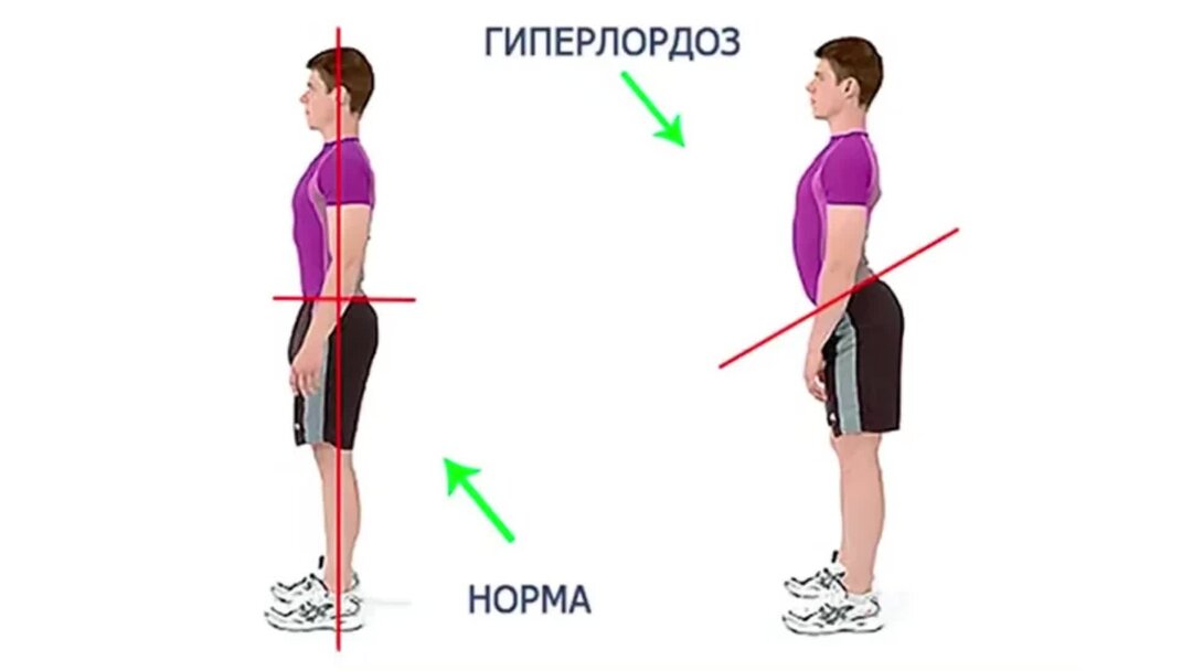 Как исправить поясницу