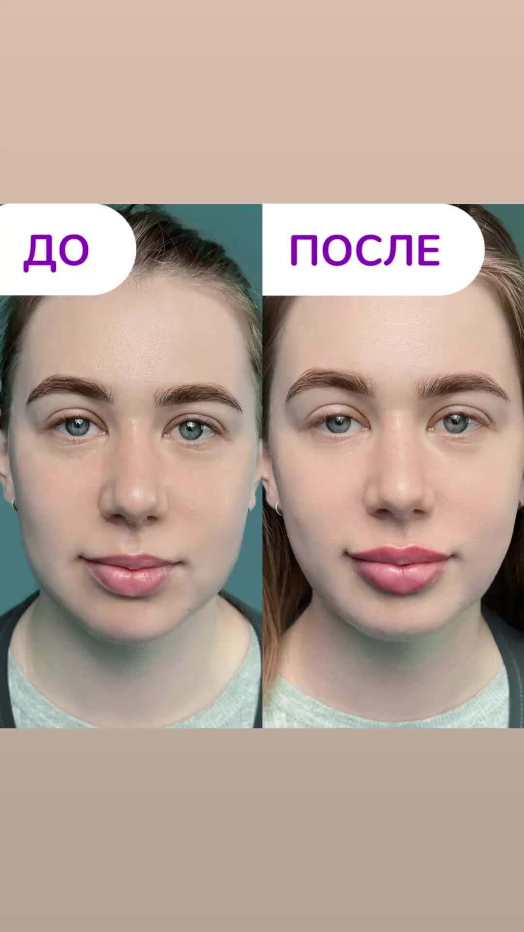 Клиника Пантеон | Знаете, как исправить асимметрию губ? Подробнее в ...