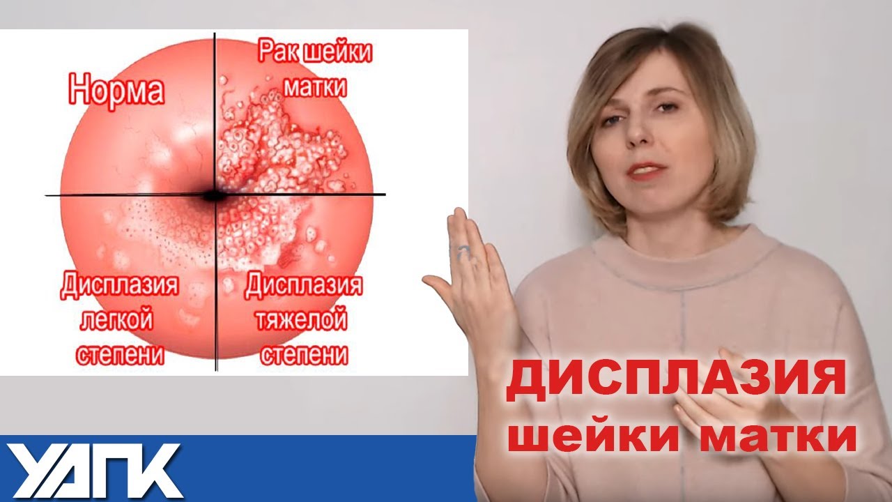 Дисплазия шейки матки код по мкб 10. Шейка матки лейкоплаки. Тяжёлая дисплазия шейки матки 3 степени. Эндоцервицит как лечить видео.
