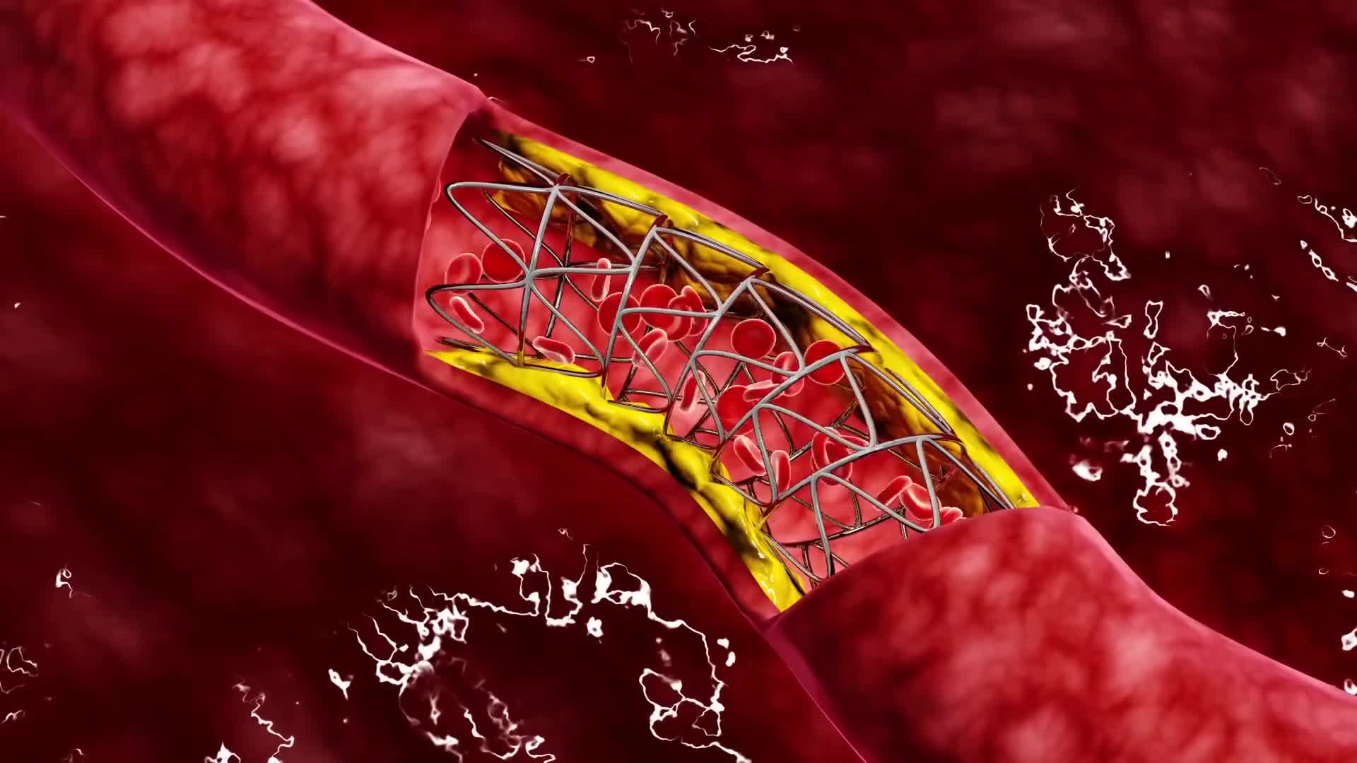 Тромбоз коронарных артерий. Стентирование коронарных артерий.