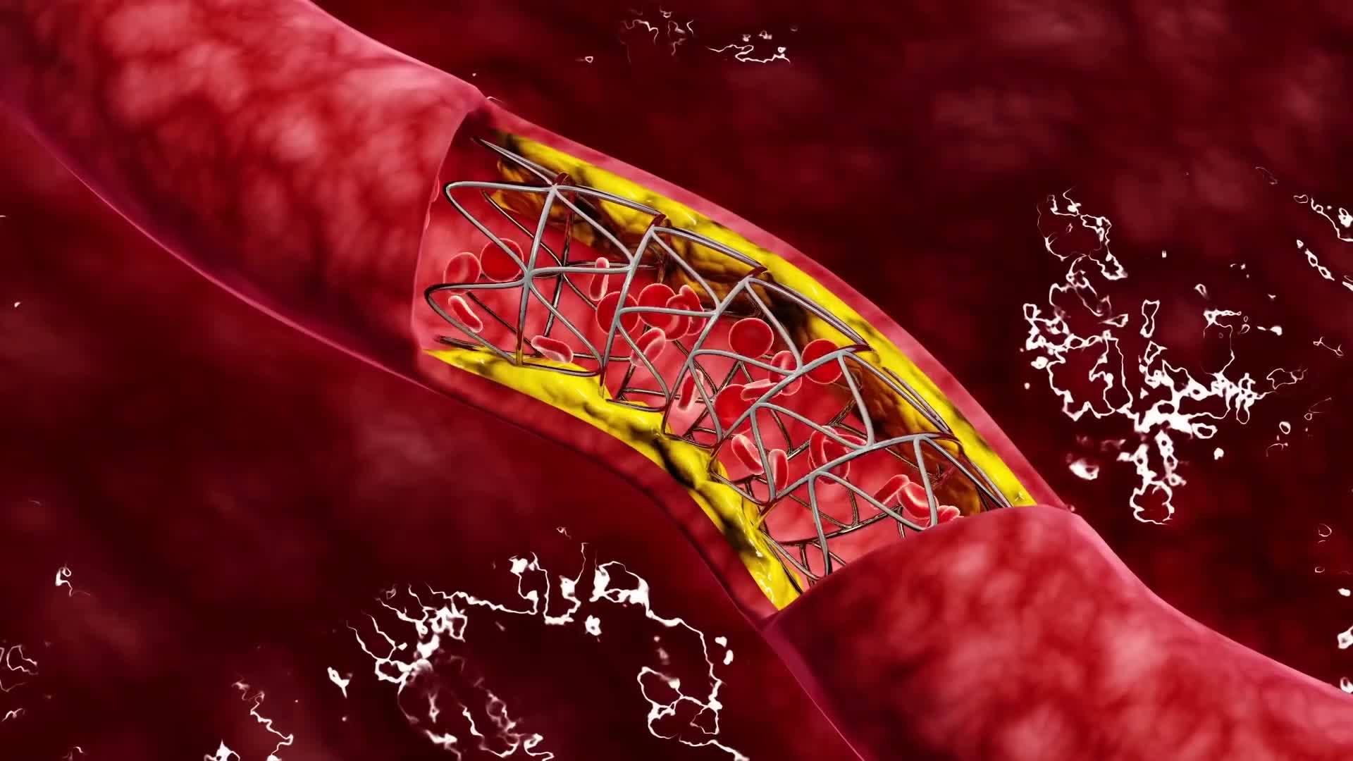 Кровь закупорка сосудов. Стентирование коронарных артерий.