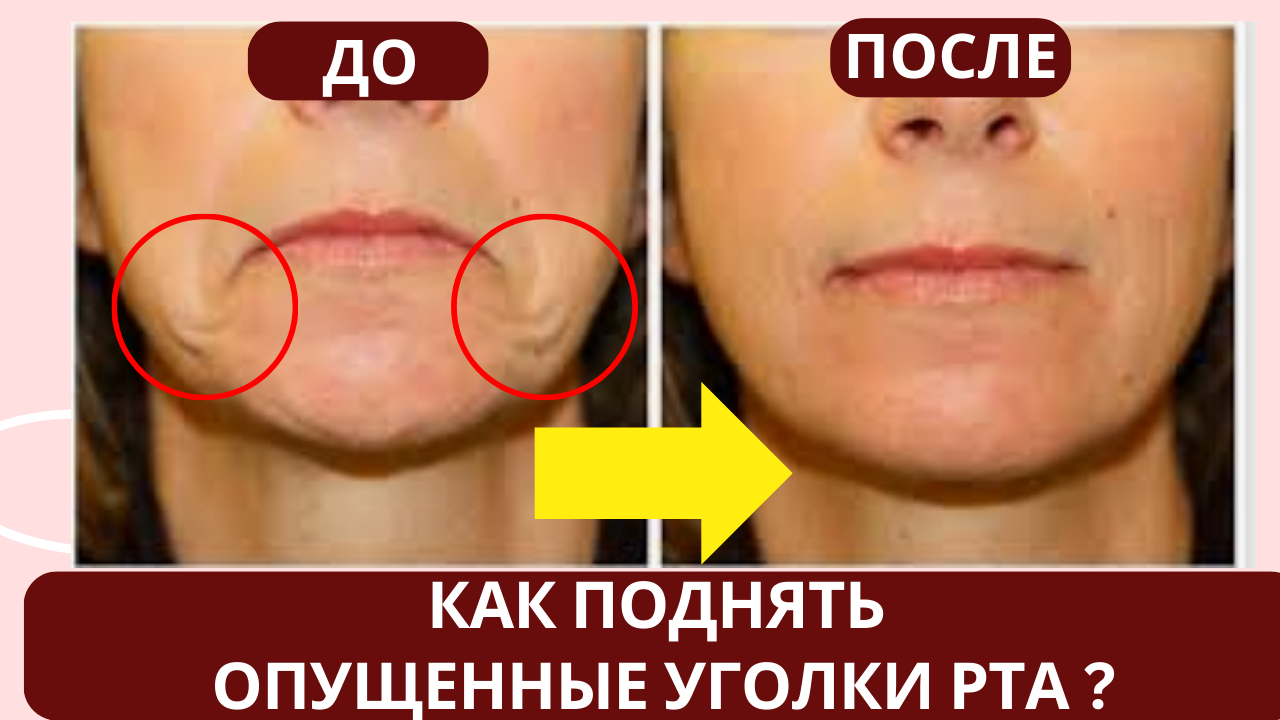 Опущены уголки губ что делать. Средства от носогубных складок. носогубные складки.