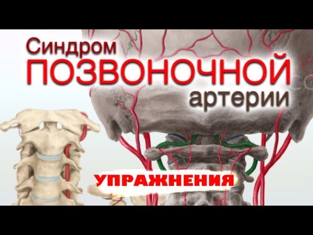 Позвоночный синдром. Синдром позвоночной артерии симптомы. Терапия синдрома позвоночной артерии. Диагноз позвоночной артерии. Синдром позвоночной артерии упражнения.