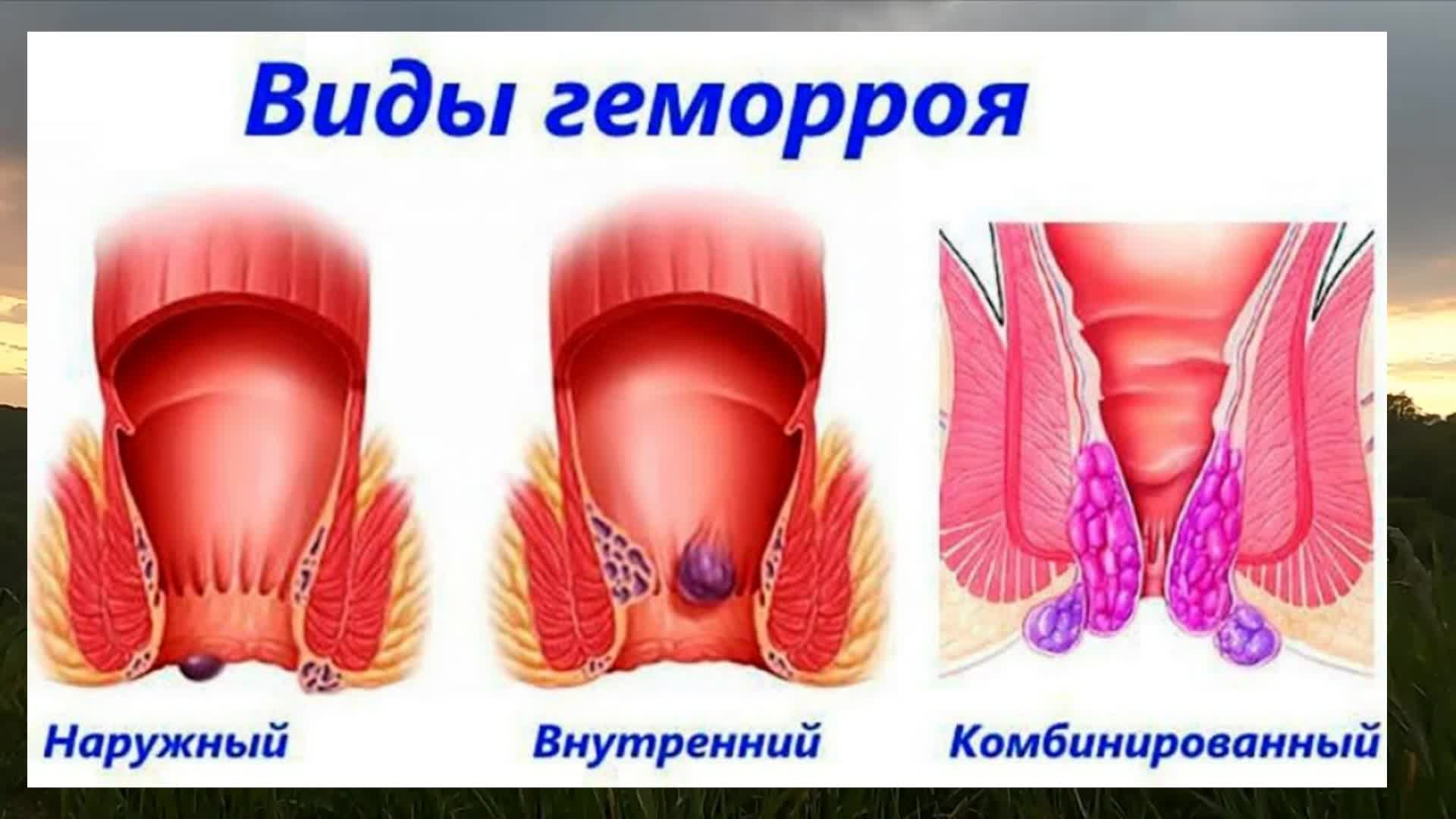 Как лечить геморрой у женщин. Гомморой.